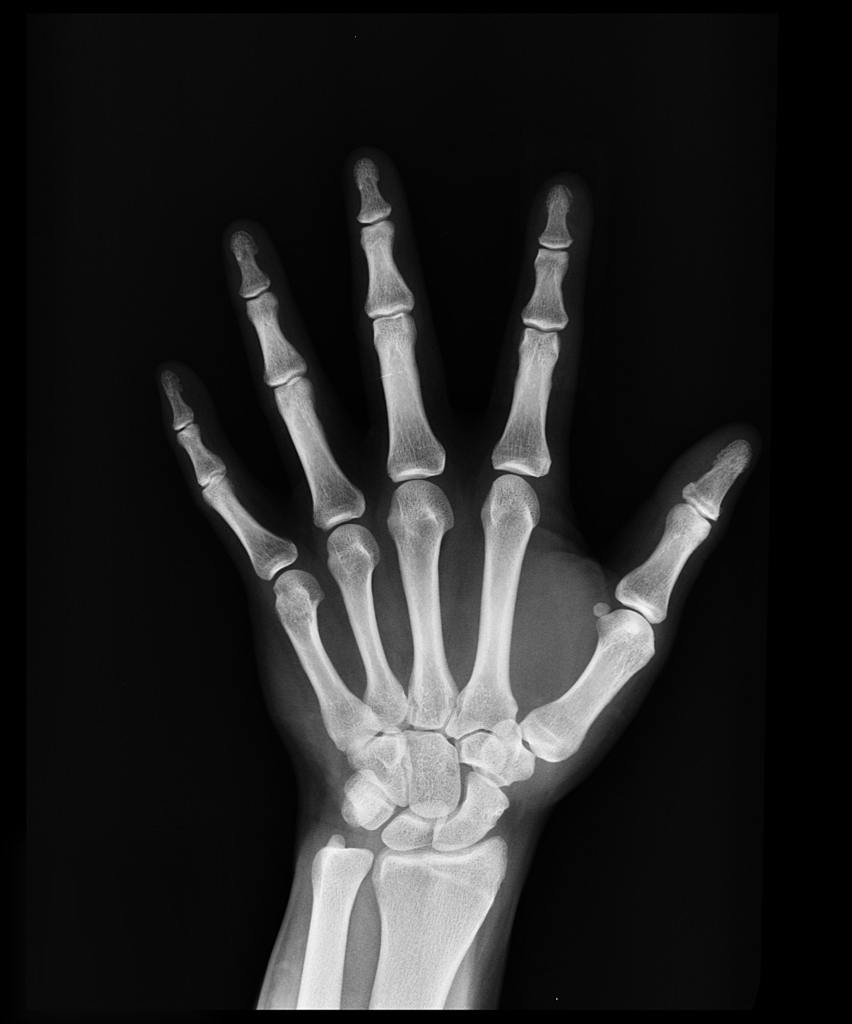 hand x ray